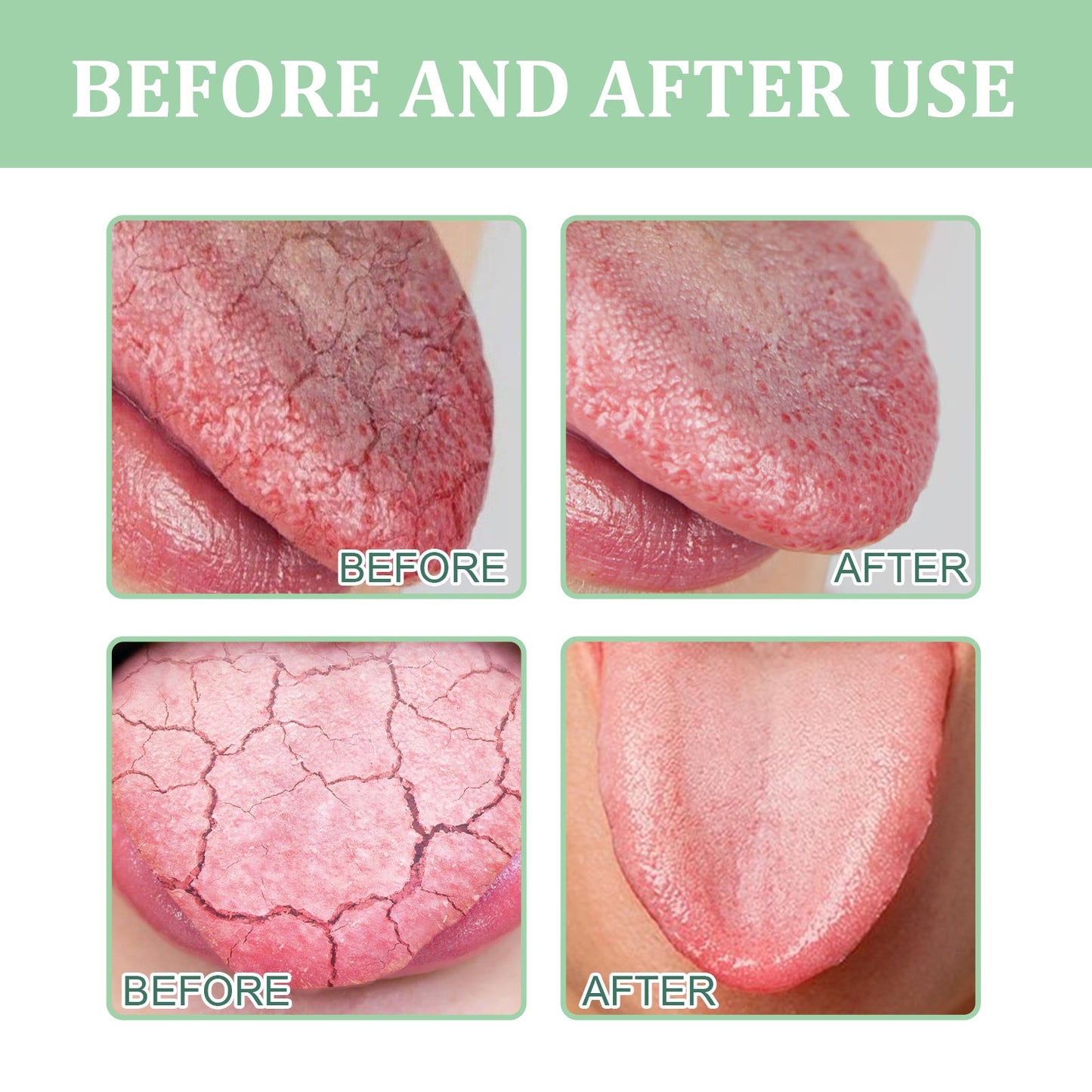 South Moon Cracked Tongue Relief Spray Relieves tongue cracks, freshens breath, and eliminates bad odor oral spray
