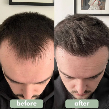 Advanced Hair Growth Roll on