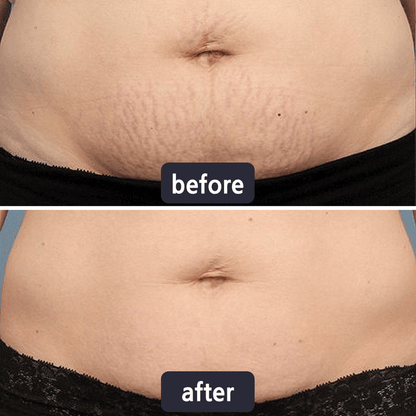 Quickly Fade New and Old Scars & Tighten Skin Repair Cream | Safe, Gentle & Suitable for Sensitive Skin